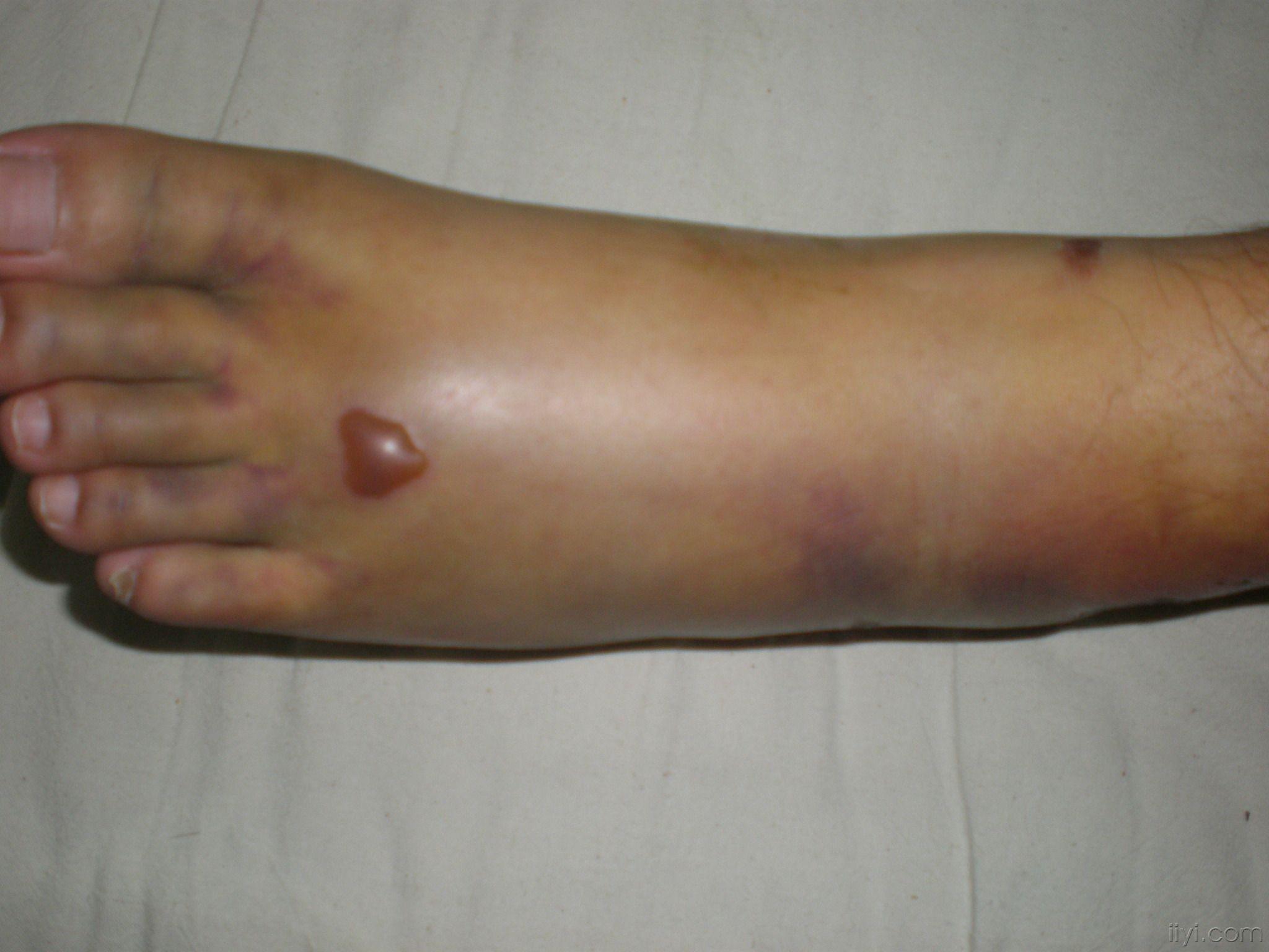 脚踝滑膜炎症状图片图片