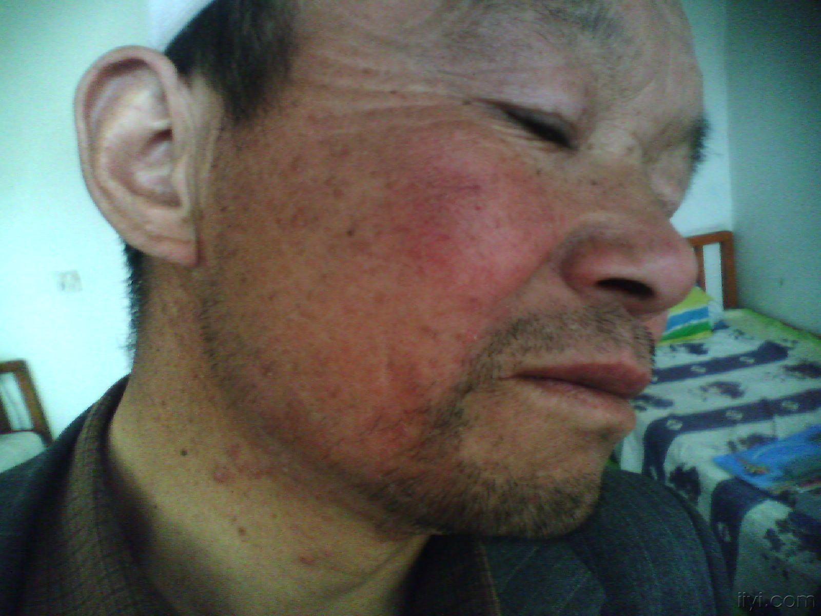 看图识病--难辨认癣