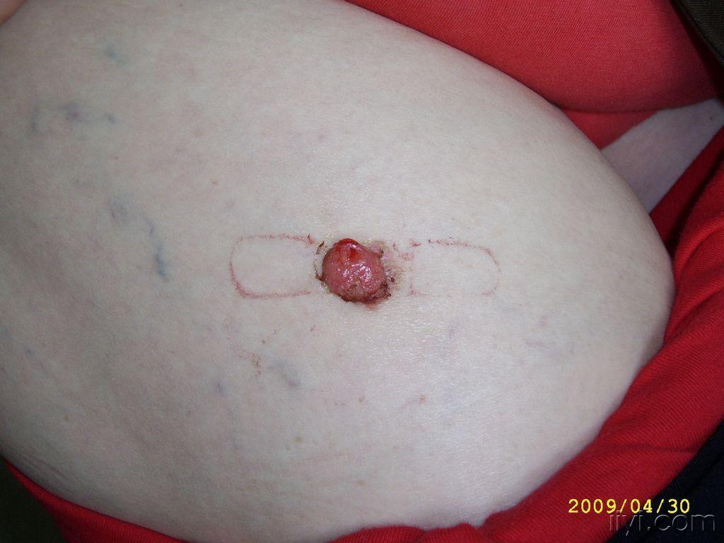 女 65岁   肿物位于右侧大腿前,大小约1.5cm*1.