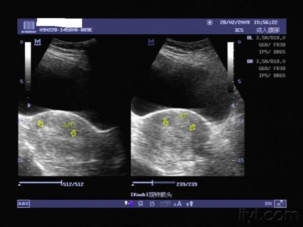 超声检查 子宫呈前位,切面大小约7.1cm×6.8cm×6.