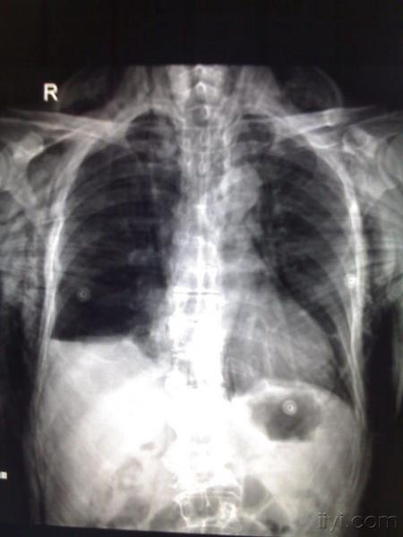 液气胸,右侧多发多处肋骨骨折,皮下气肿,纵隔积气