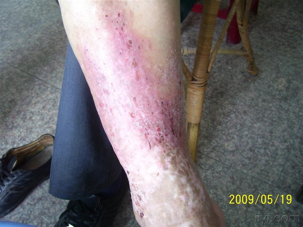 淤积性皮炎伴体癣 - 皮肤及性传播疾病讨论版 - 爱爱医医学论坛