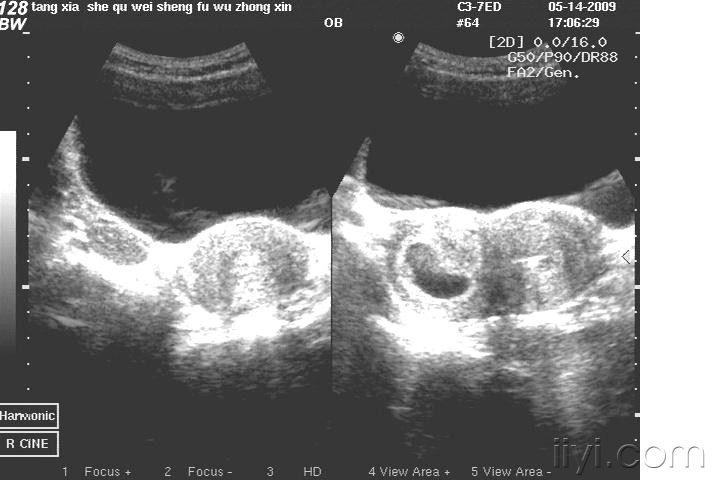 原创:双角子宫右侧妊娠,左侧节育器