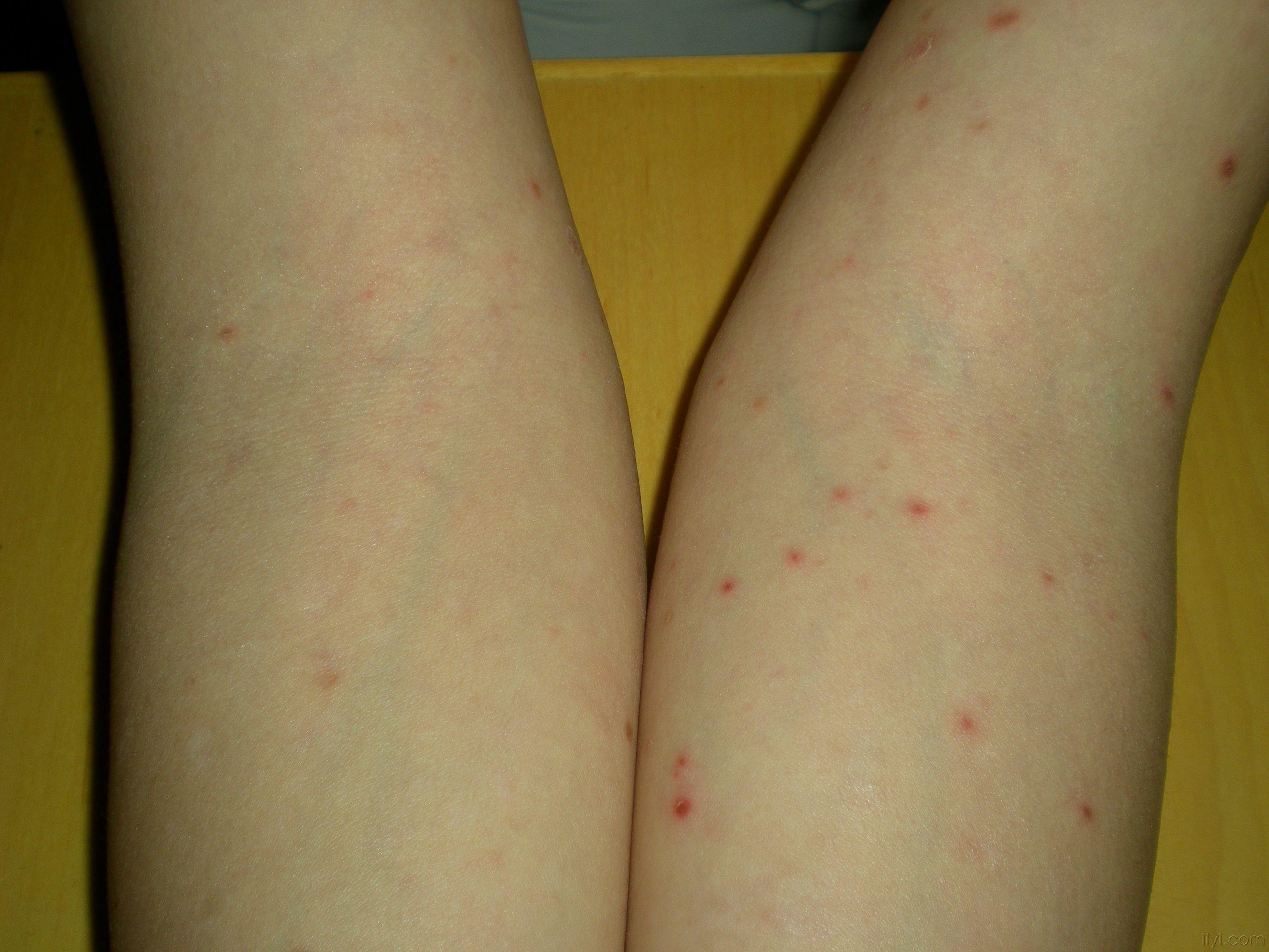 看图识病 - 皮肤及性传播疾病讨论版 - 爱爱医医学论坛 - 爱爱医医学