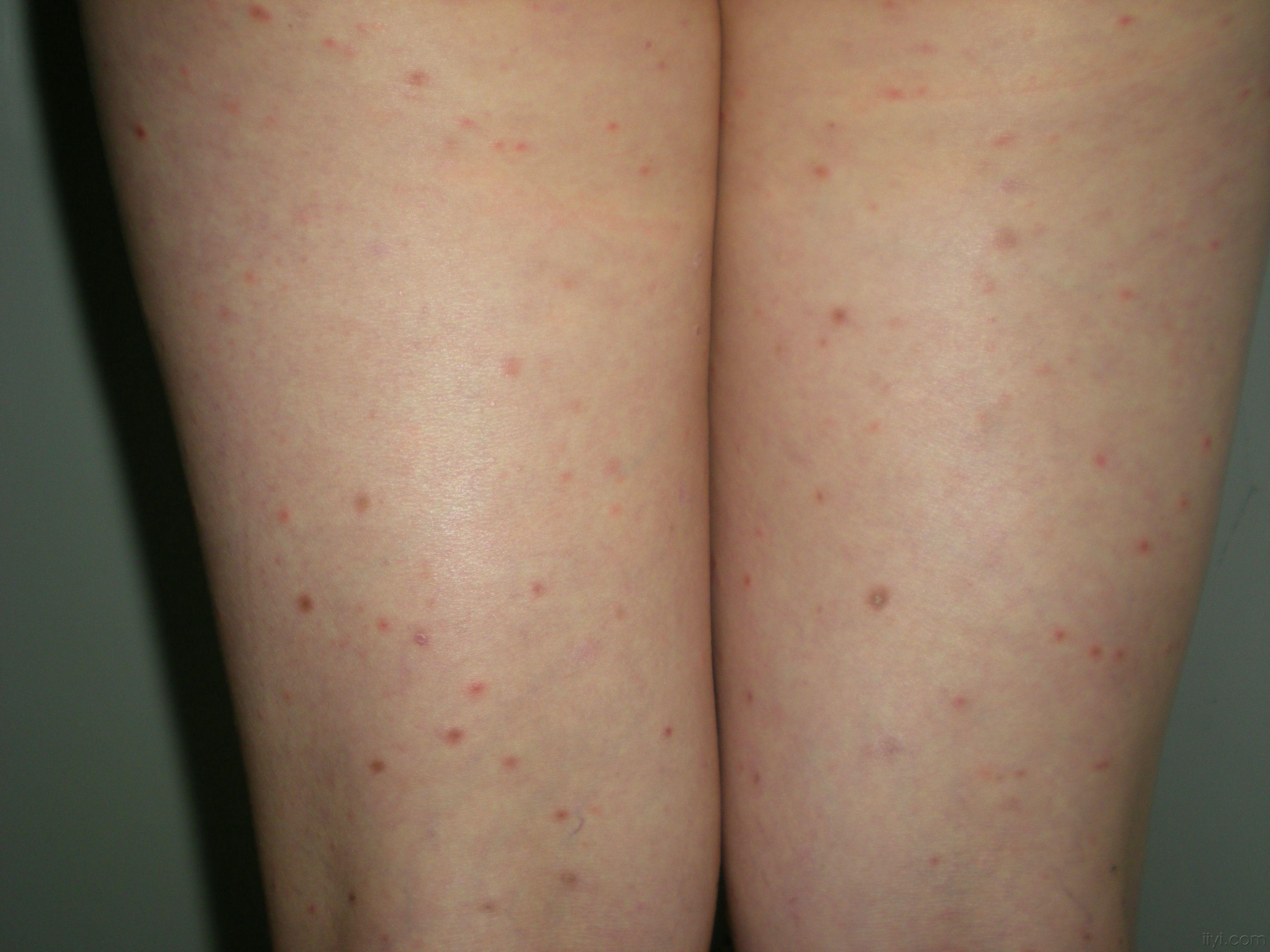 诊断:副银屑病  [ 本帖最后由 happymi 于 2009-5-29 21:55 编辑 ]