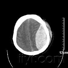 腦外傷,左側硬膜外血腫