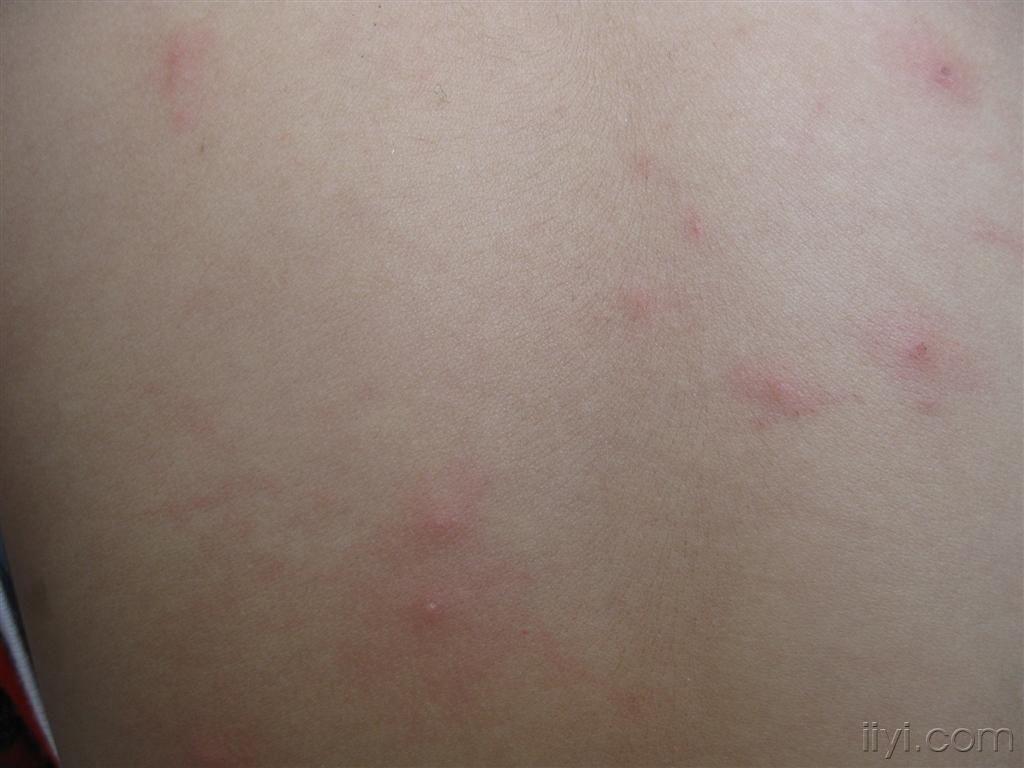 丘疹性荨麻疹