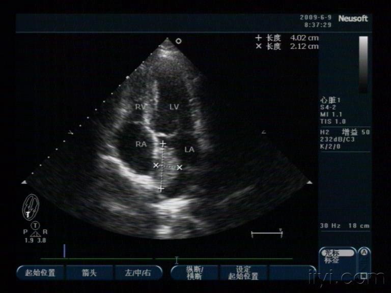 左心房附壁血栓图片图片
