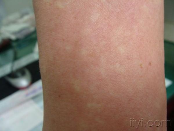 典型病例——marshall-white综合征