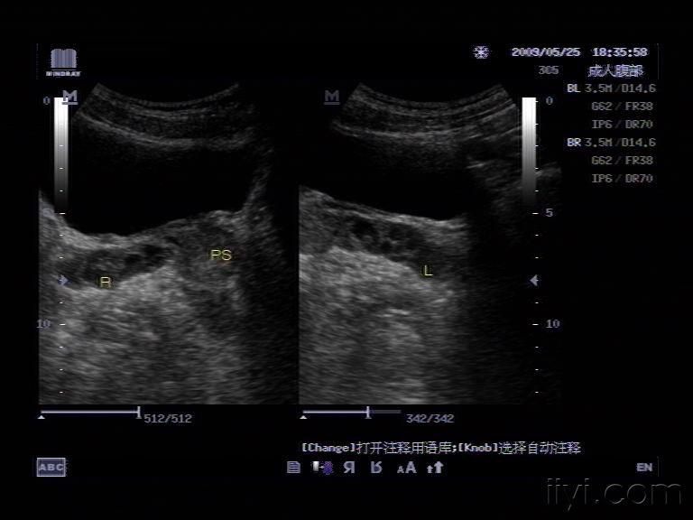 精囊腺超声图片图片