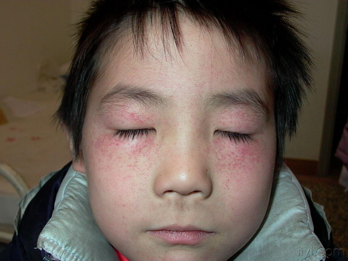 儿童紫癜病症状的图片图片