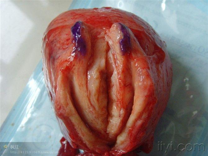 恶性子宫肌瘤图片