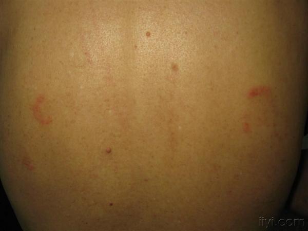 发现双侧臀部红斑一周,无痛痒.涂癣药无效,后又发现背部两个小的红斑.
