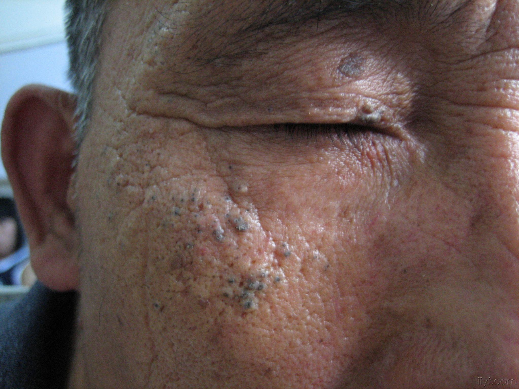 结节性类弹力纤维病