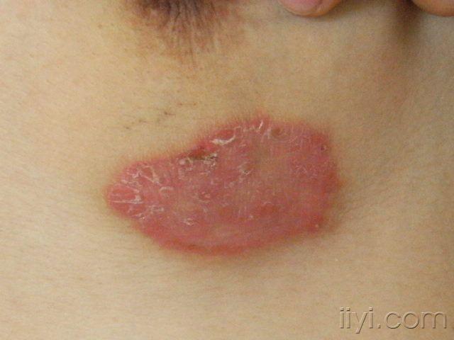 16岁乳房湿疹图片