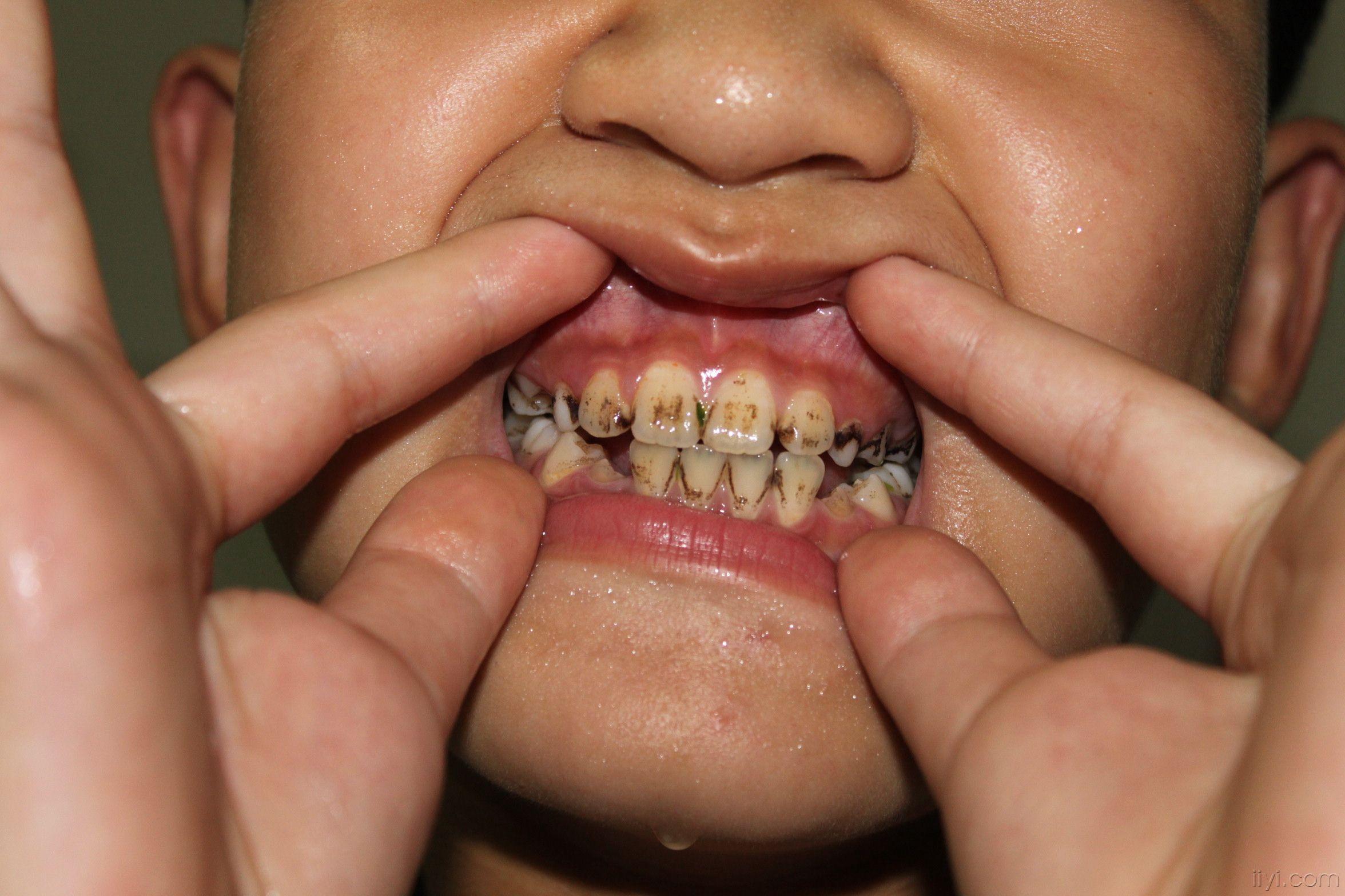 儿童牙釉质发育不全图图片