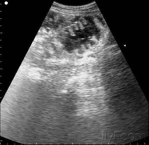 大家看看可以报肠梗阻吗?