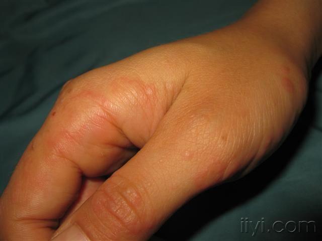 看图识病.手部可疑多形红斑