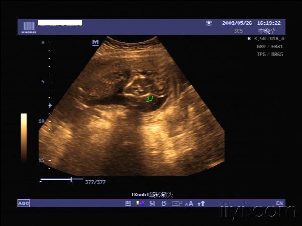胎儿核磁共振结果图片图片