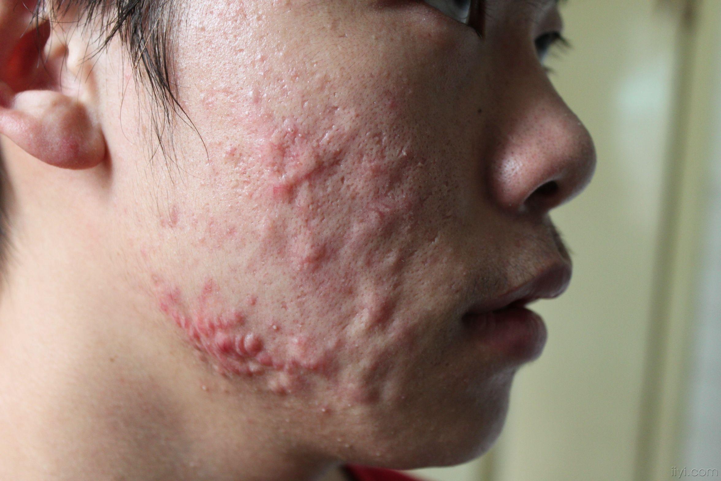 面部囊肿性痤疮,请教高手治疗办法.