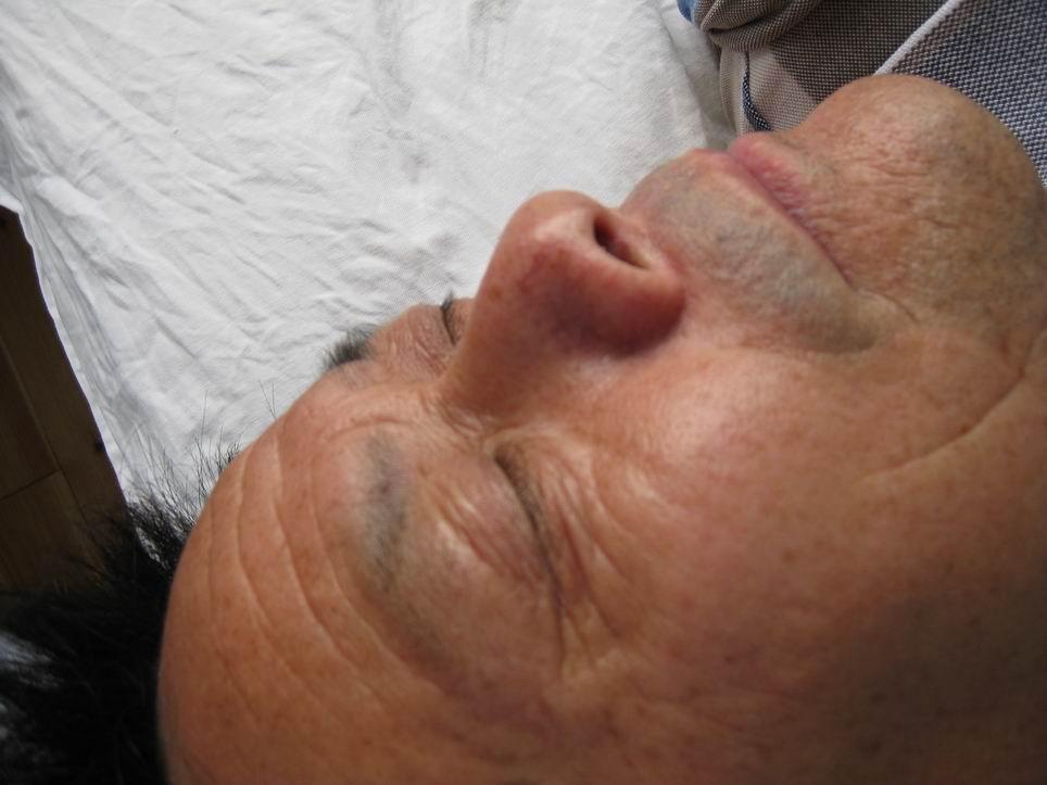 三个中风病人我当怎样治