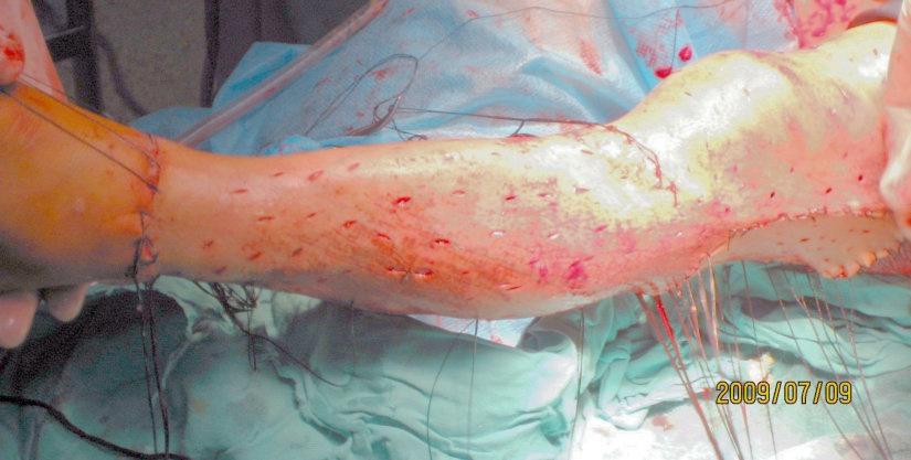 14:30:238岁女孩,卡车轮碾挫伤,皮肤剥脱伤,肌肉软组织搓灭,胫前血管