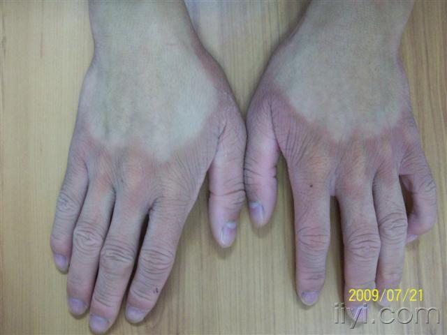 你看看 - 皮肤及性传播疾病讨论版 - 爱爱医医学论坛 - 爱爱医医学网