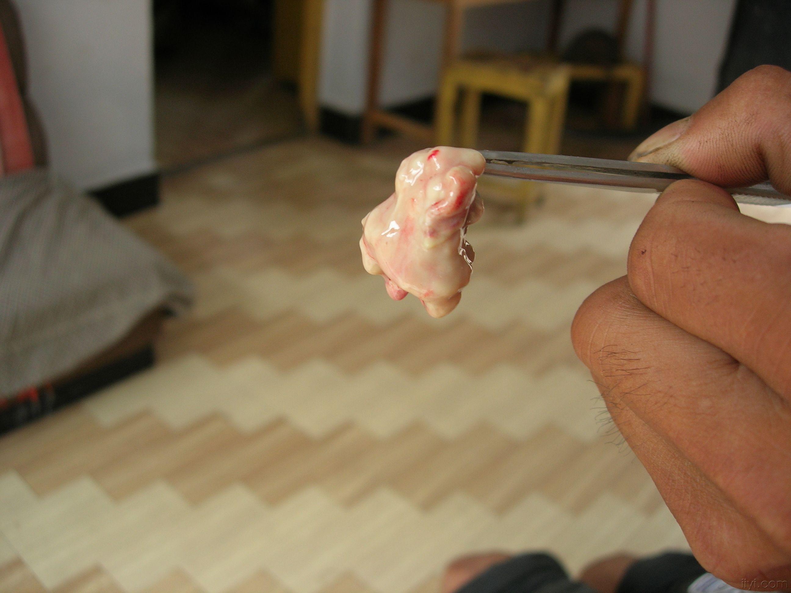 搭背疮之上搭手生于肺腧穴图片