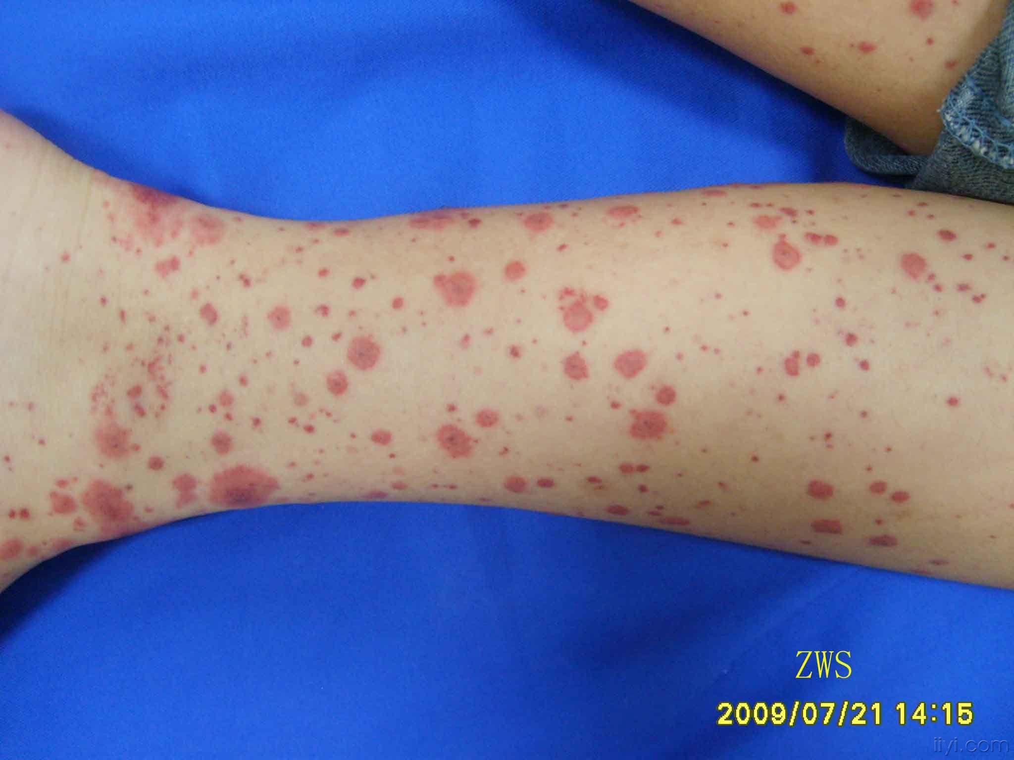 血管炎荨麻疹症状图片
