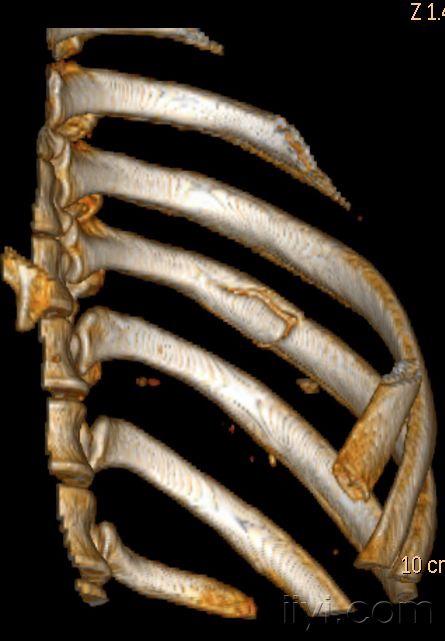 讀片|疑似肋骨病理性骨折一例|dr ct