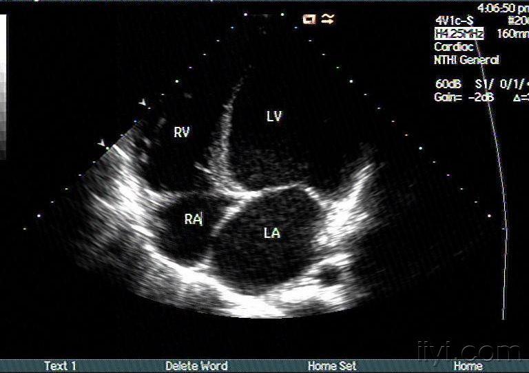 扩张型心肌病彩超图片