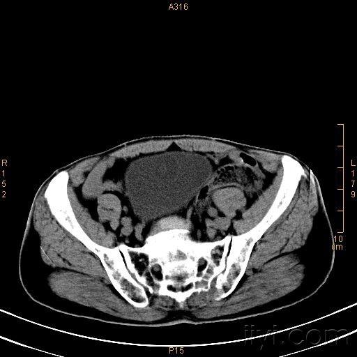 盆腔(骨盆)占位性病变,请您讨论,有病理!(结果已出,在23楼)