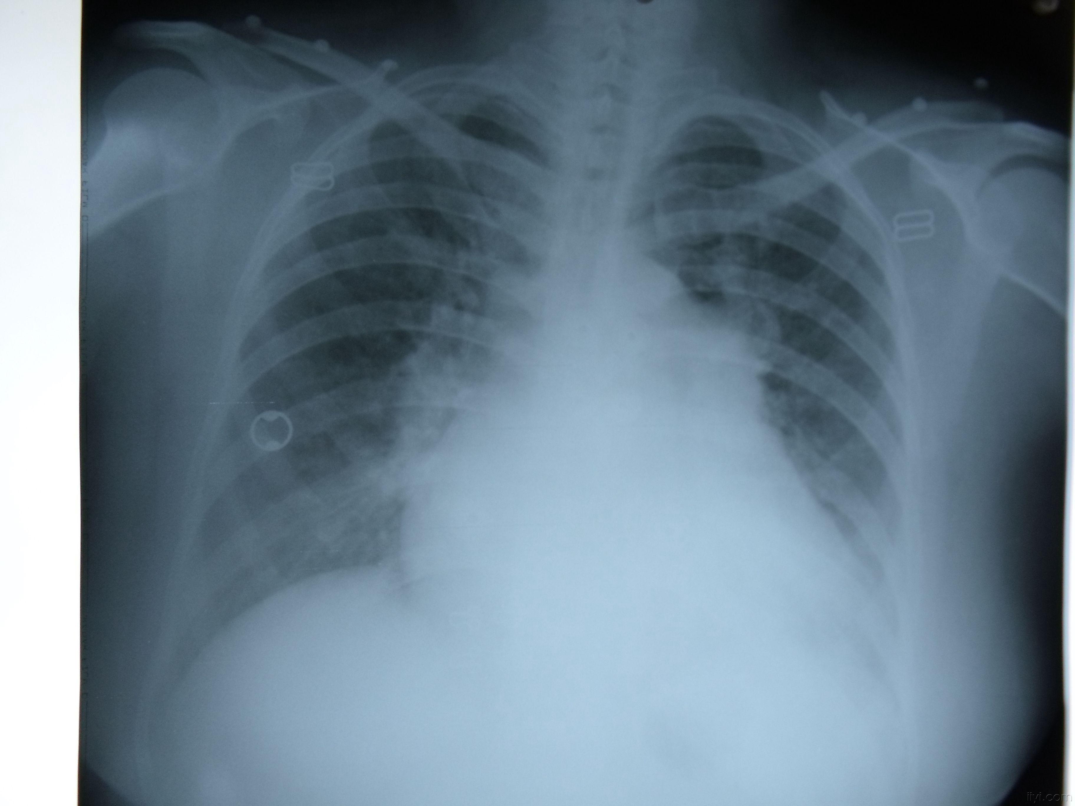 女 咳嗽一周,胸部平片