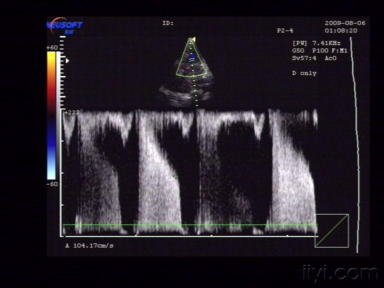 风心:二尖瓣狭窄(典型,不看可惜) 