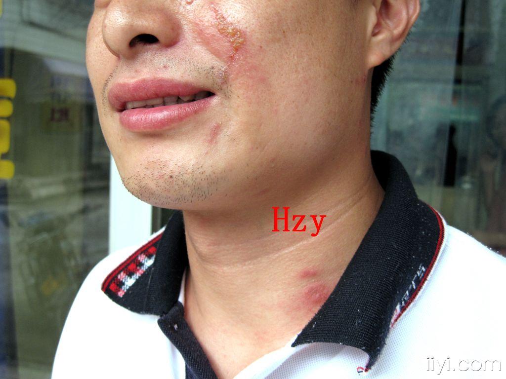 楼主236373582009-08-10 22:06:55请诊断  公布答案:隐翅虫皮炎  [ 本