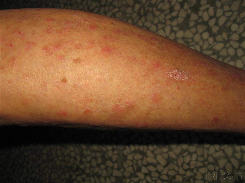 看图识病.银屑病吗?