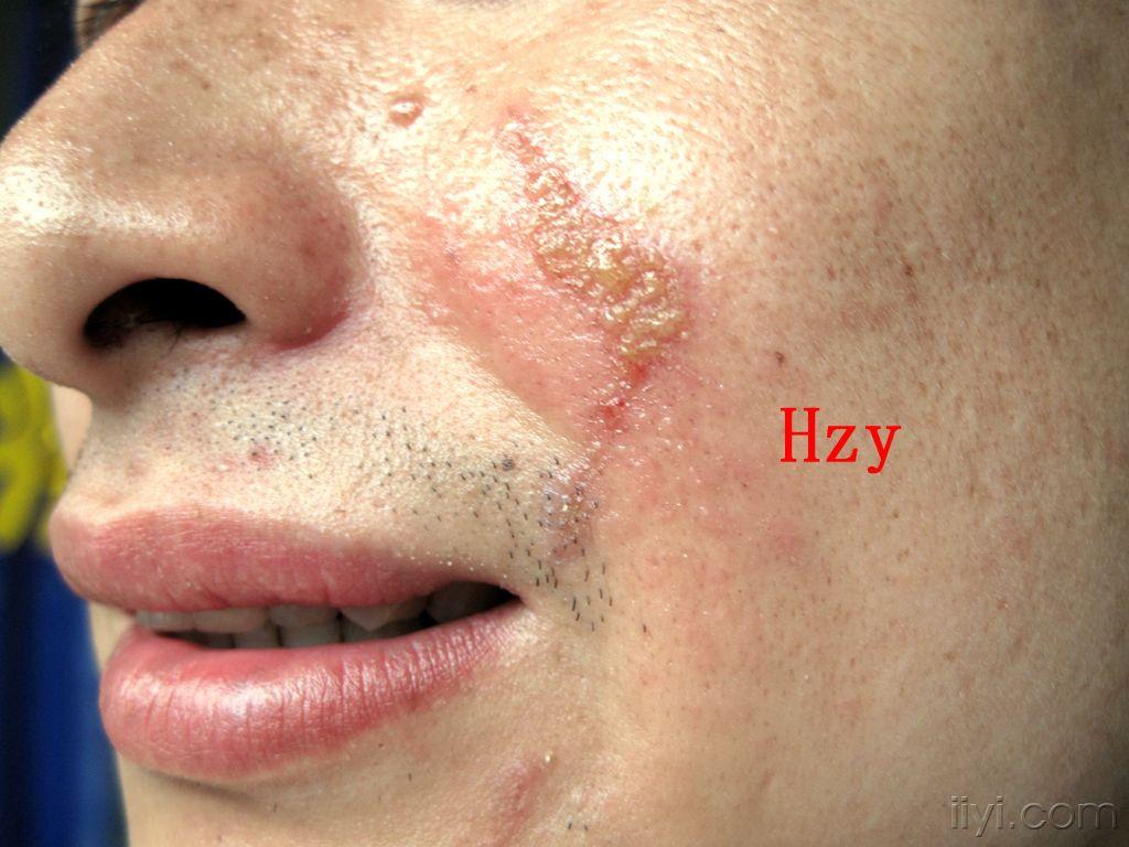 早晨感到左脸及颈部有点疼,第二天就有了图片上这样的皮损.