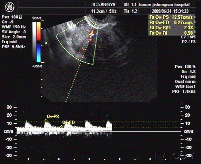 阴超发现一例宫外孕