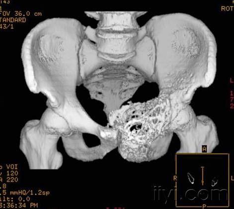 [讀片]骨盆病變/dr,ct及mr/病理已公佈/20090811