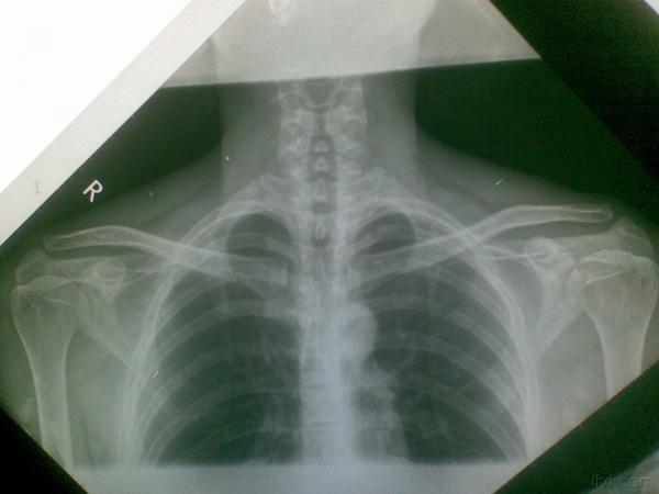 胸锁关节拍片位置图片
