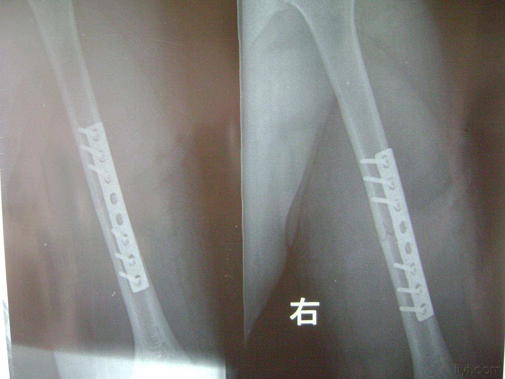 肱骨干干骨折选择什么样的内固定(术后片)