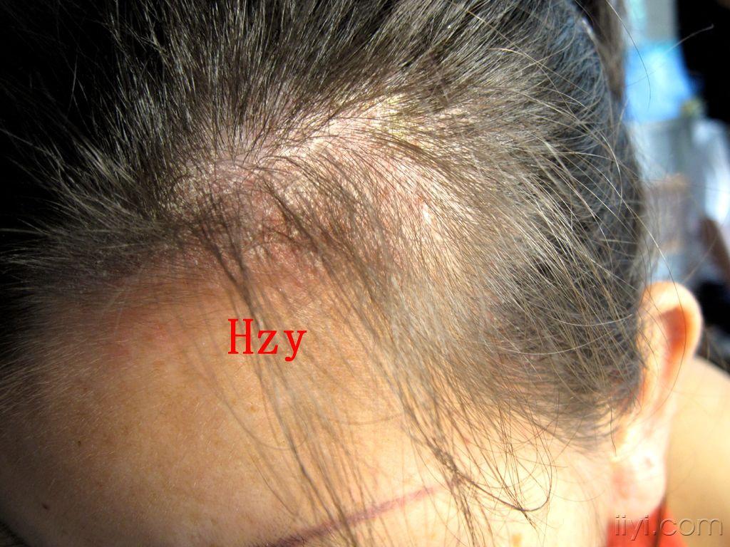 他前发际部位的皮损是什么?