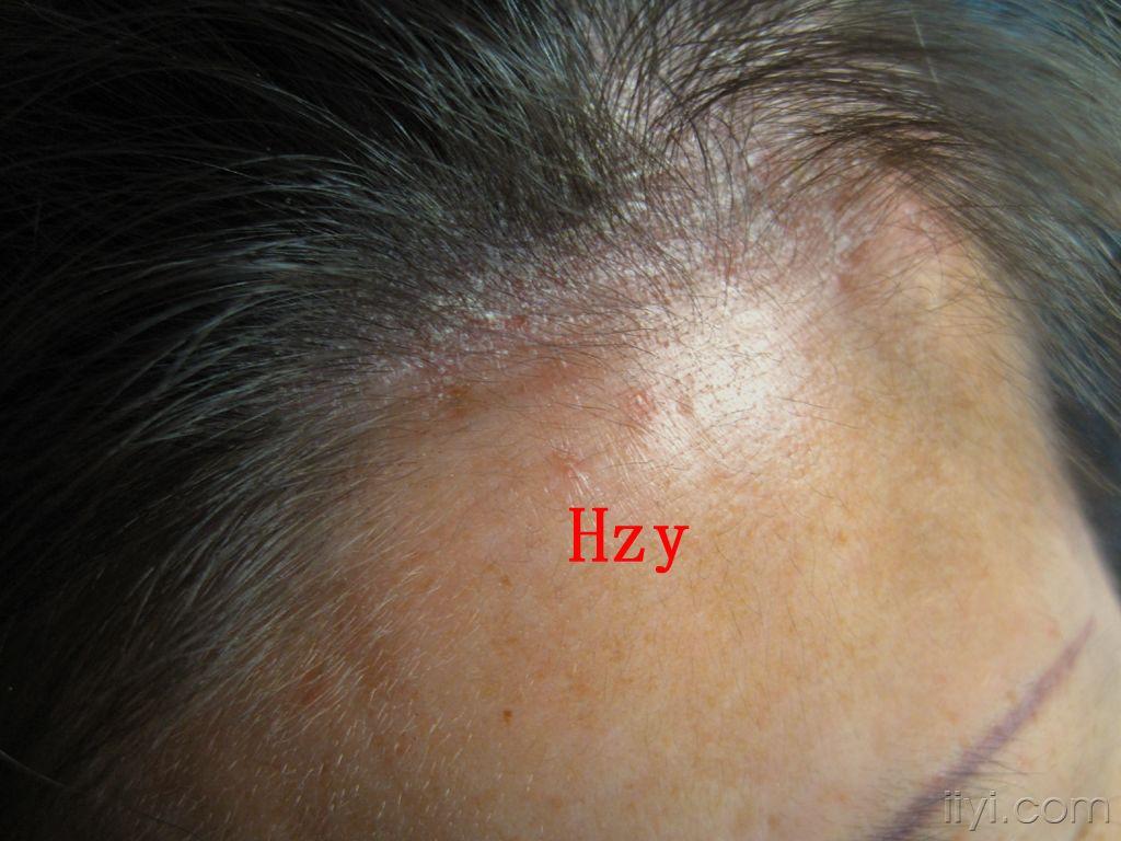 他前发际部位的皮损是什么?