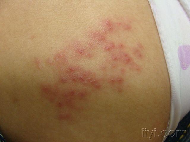 1型疱疹的症状图片图片