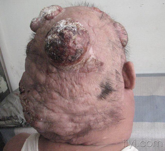 考虑:蕈样肉芽肿{  经北大会诊并进一步免疫组化,结