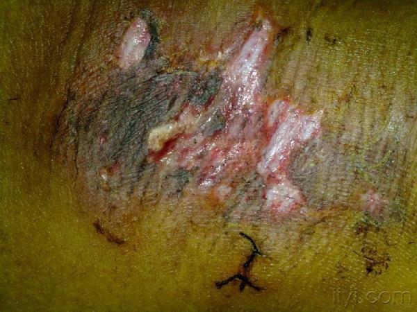 狐臭伤口感染的图片图片