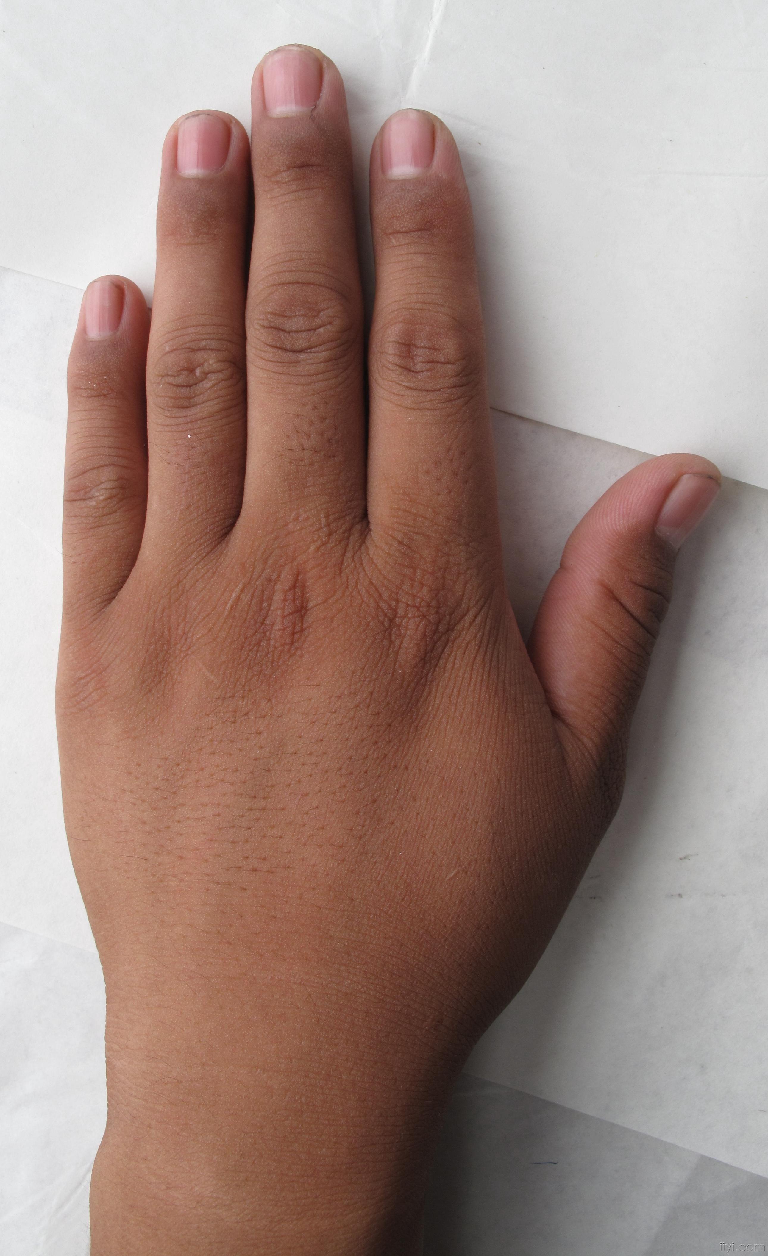 瘢痕体质,手背皮肤细沙样小点.