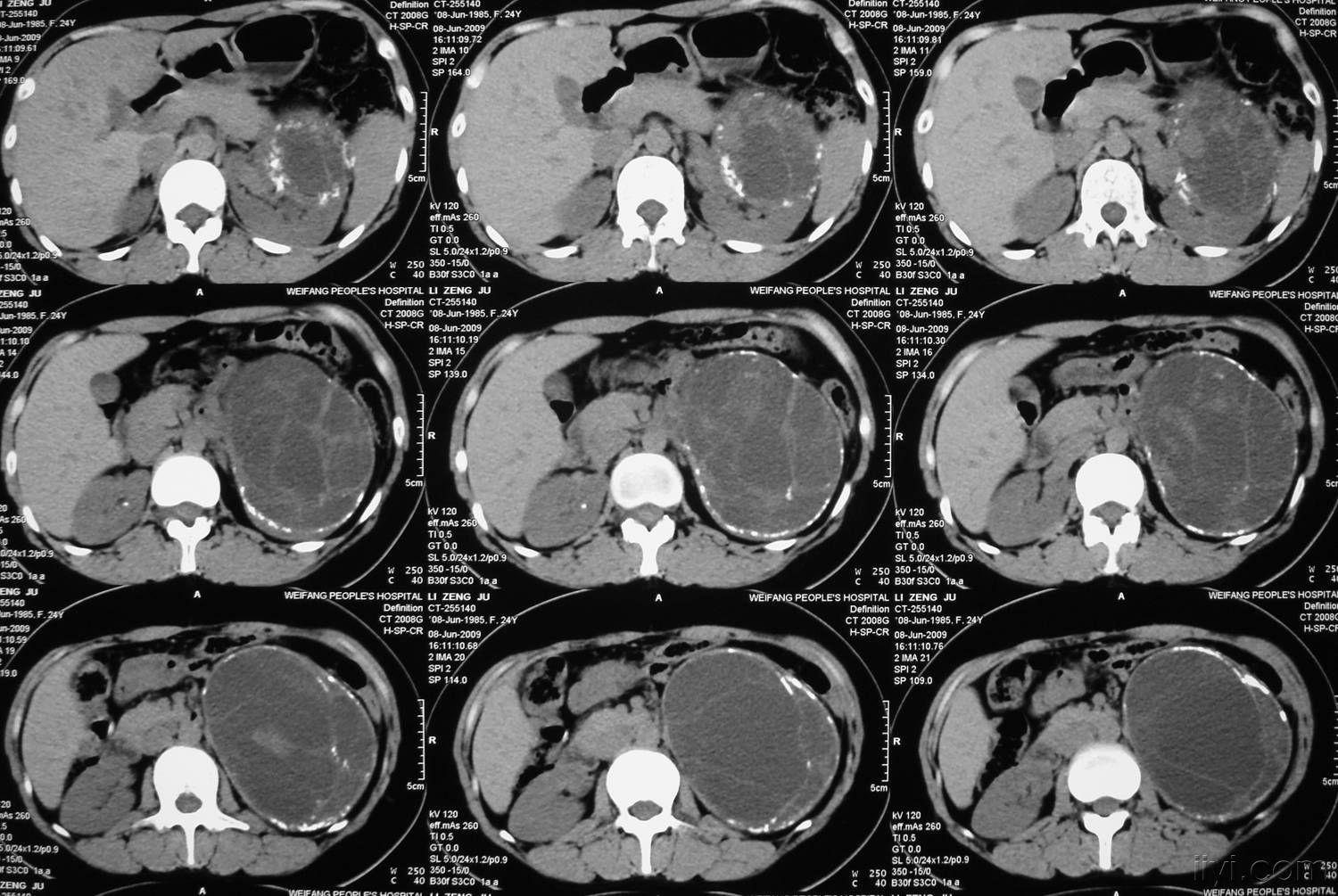 左腎臟囊性病變,已經公佈病理-病理為囊性腎癌