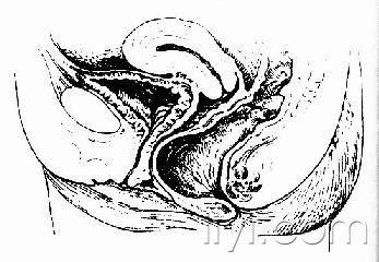 关于女性尿潴留的猜想