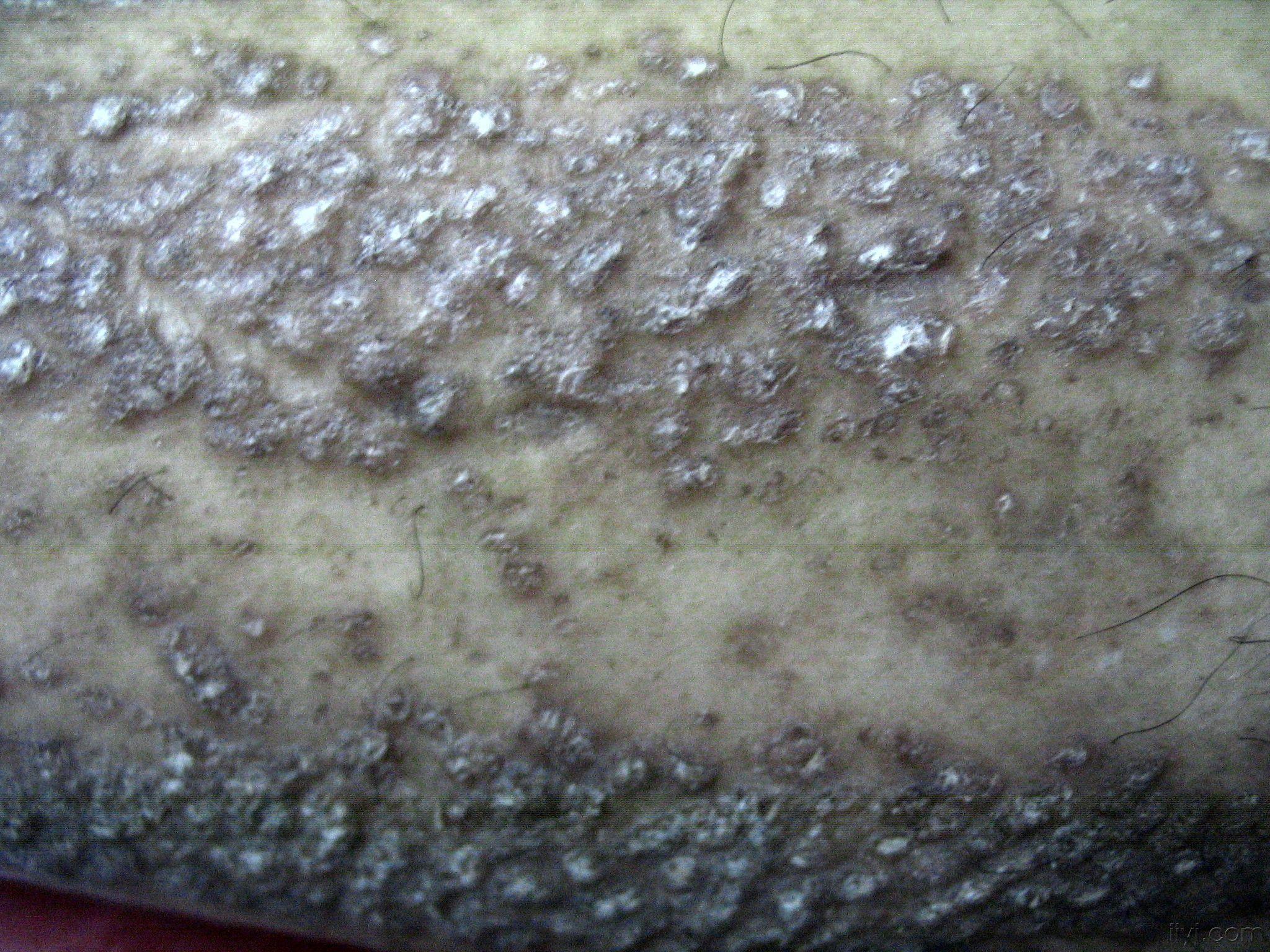 四肢伸侧及臀部腰部大片皮疹,剧痒,遇热加重,未经特殊治疗,用皮炎宁酊